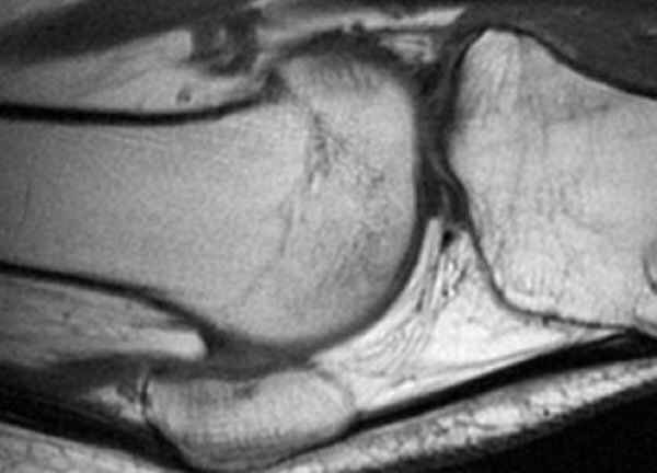 Articulación con Artritis